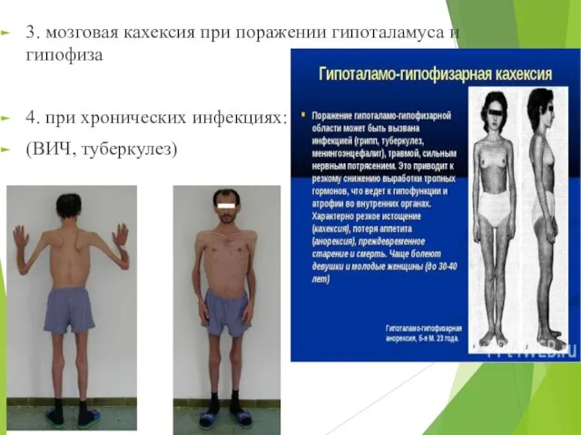 3. мозговая кахексия при поражении гипоталамуса и гипофиза 4. при хронических инфекциях: (ВИЧ, туберкулез)