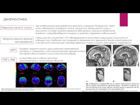 Диагностика. у большинства пациентов с ПНП обнаруживаются когнитивные нарушения чаще всего