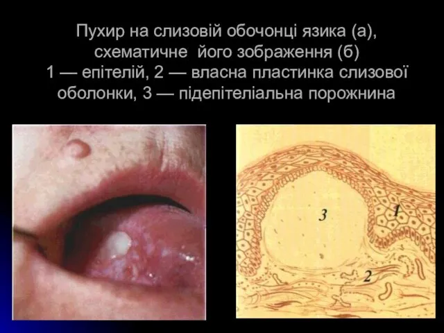 Пухир на слизовій обочонці язика (а), схематичне його зображення (б) 1