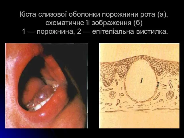 Кіста слизової оболонки порожнини рота (а), схематичне їі зоб­раження (б) 1