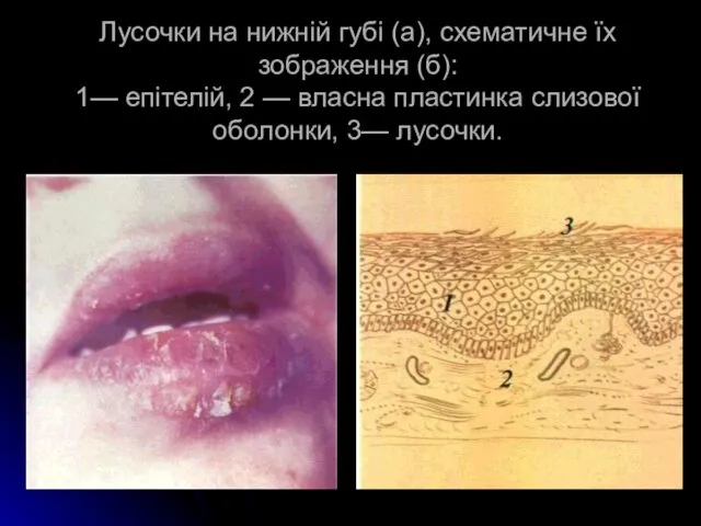 Лусочки на нижній губі (а), схематичне їх зображення (б): 1— епітелій,