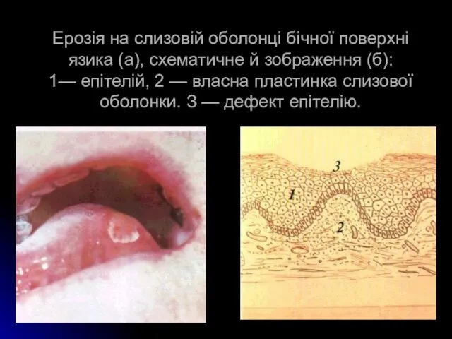 Ерозія на слизовій оболонці бічної поверхні язика (а), схематичне й зображення