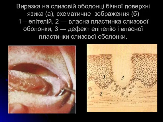 Виразка на слизовій оболонці бічної поверхні язика (а), схематичне зображення (б)