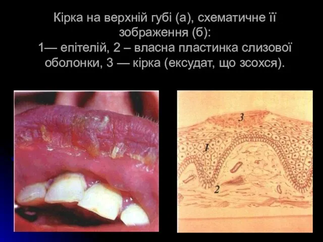 Кірка на верхній губі (а), схематичне її зображення (б): 1— епітелій,