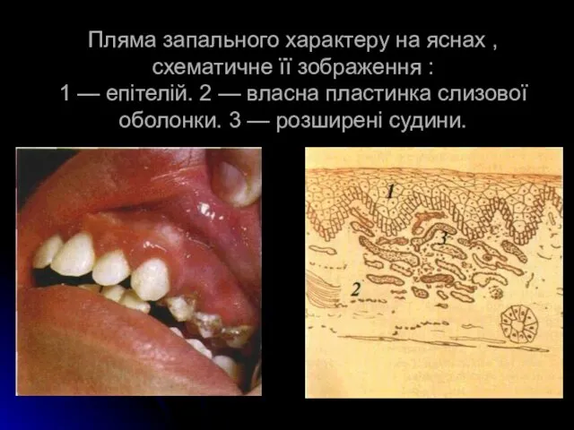 Пляма запального характеру на яснах , схематичне її зобра­ження : 1