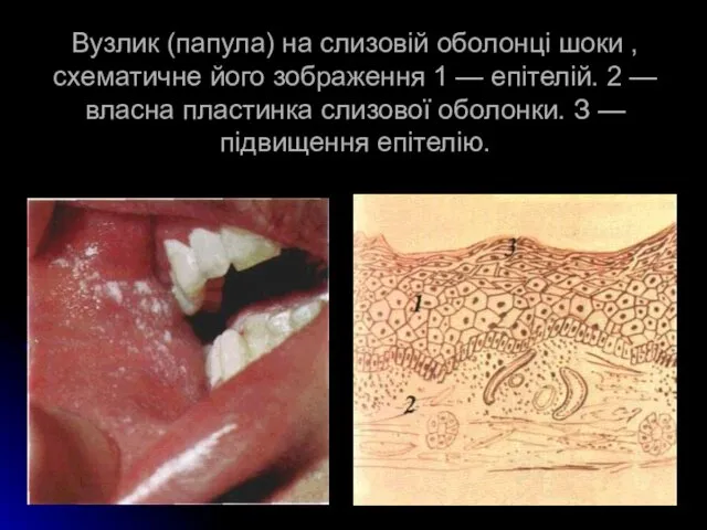 Вузлик (папула) на слизовій оболонці шоки , схематичне його зображення 1