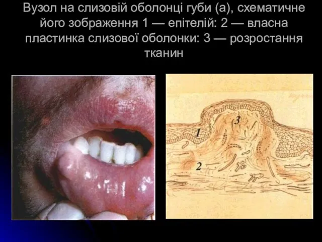 Вузол на слизовій оболонці губи (а), схематичне його зображення 1 —