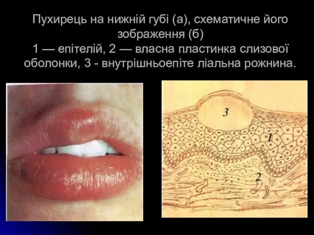 Пухирець на нижній губі (а), схематичне його зображення (б) 1 —