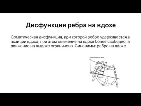 Дисфункция ребра на вдохе Соматическая дисфункция, при которой ребро удерживается в