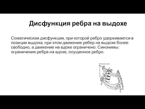 Дисфункция ребра на выдохе Соматическая дисфункция, при которой ребро удерживается в