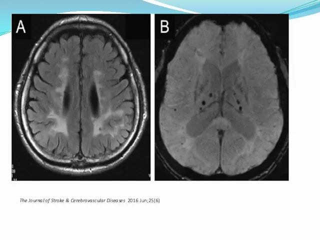 The Journal of Stroke & Cerebrovascular Diseases 2016 Jun;25(6)