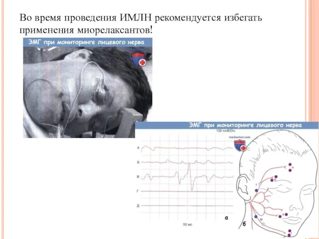 Во время проведения ИМЛН рекомендуется избегать применения миорелаксантов!