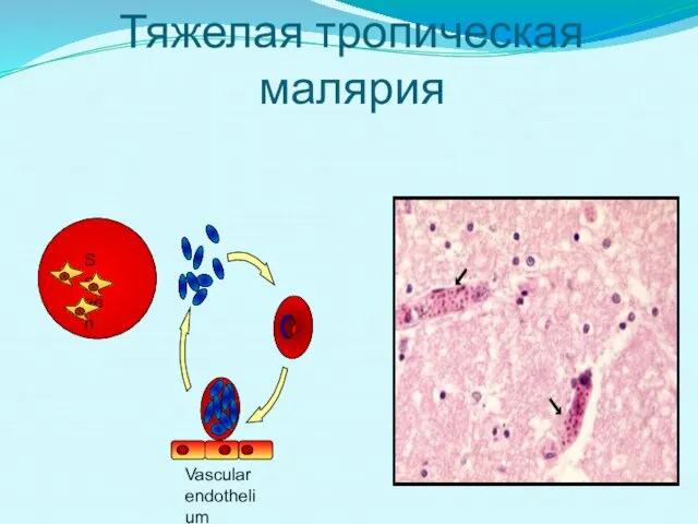 Тяжелая тропическая малярия