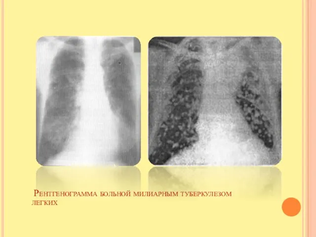 Рентгенограмма больной милиарным туберкулезом легких