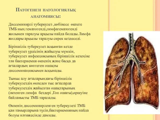 Патогенезі патологиялық анатомиясы: Диссеминирлі туберкулез ,көбінесе өкпеге ТМБ ның гематогенді,лимфагематогенді жолымен