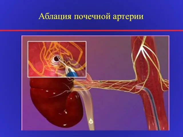 Аблация почечной артерии