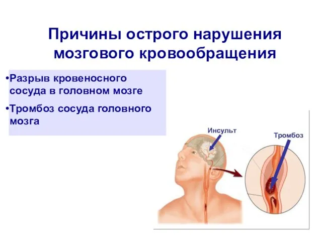 Причины острого нарушения мозгового кровообращения Разрыв кровеносного сосуда в головном мозге Тромбоз сосуда головного мозга