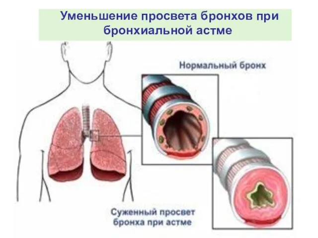 Уменьшение просвета бронхов при бронхиальной астме Уменьшение просвета бронхов при бронхиальной астме