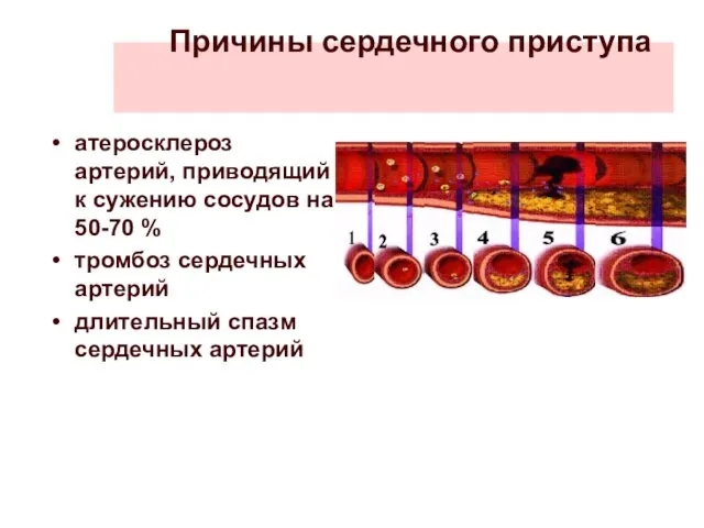 Причины сердечного приступа атеросклероз артерий, приводящий к сужению сосудов на 50-70