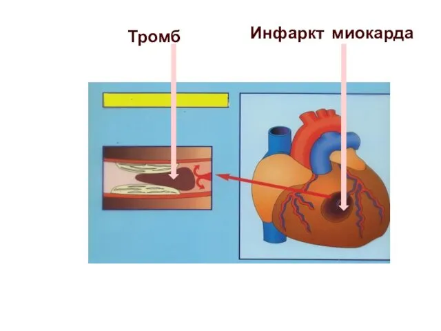 Инфаркт миокарда Тромб