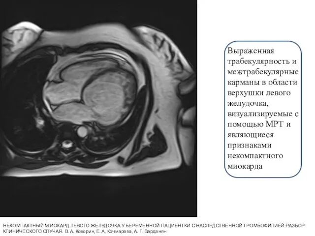 Выраженная трабекулярность и межтрабекулярные карманы в области верхушки левого желудочка, визуализируемые
