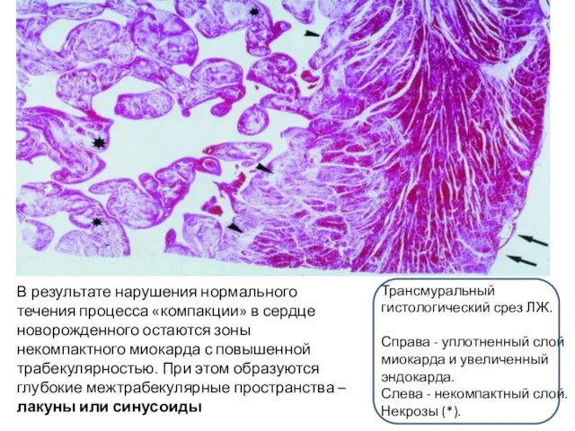 Трансмуральный гистологический срез ЛЖ. Справа - уплотненный слой миокарда и увеличенный