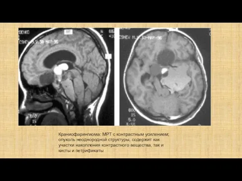 Краниофарингиома: МРТ с контрастным усилением; опухоль неоднородной структуры, содержит как участки