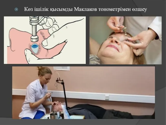 Көз ішілік қысымды Маклаков тонометрімен өлшеу