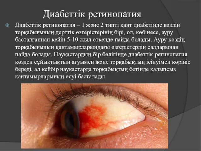 Диабеттік ретинопатия Диабеттік ретинопатия – 1 және 2 типті қант диабетінде
