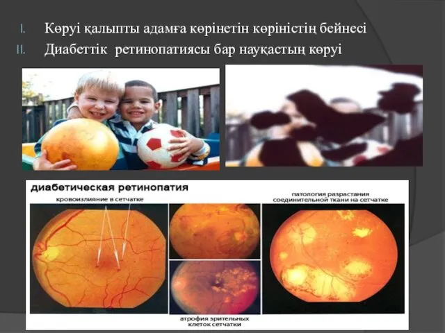 Көруі қалыпты адамға көрінетін көріністің бейнесі Диабеттік ретинопатиясы бар науқастың көруі