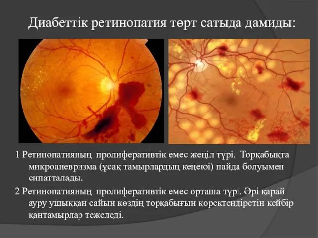 Диабеттік ретинопатия төрт сатыда дамиды: 1 Ретинопатияның пролиферативтік емес жеңіл түрі.