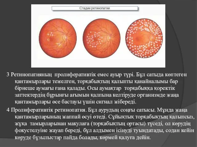 3 Ретинопатияның пролиферативтік емес ауыр түрі. Бұл сатыда көптеген қантамырлары тежелген,