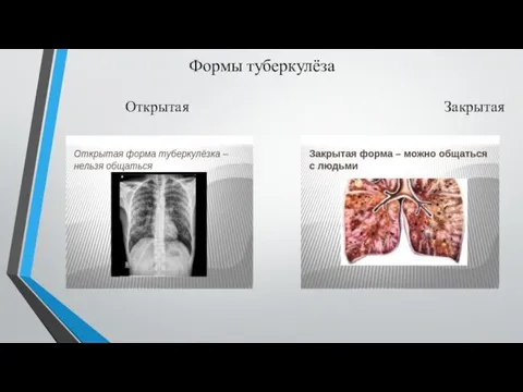 Формы туберкулёза Открытая Закрытая