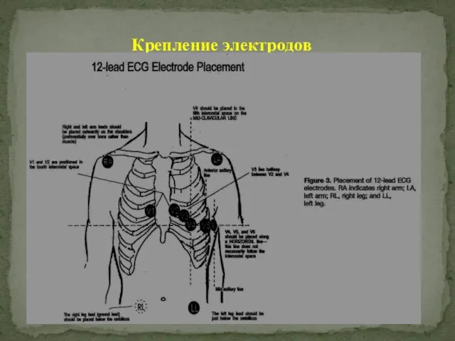 Крепление электродов