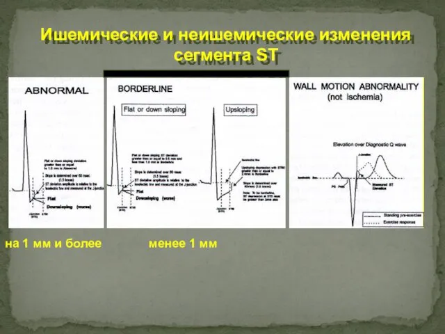 Ишемические и неишемические изменения сегмента ST на 1 мм и более менее 1 мм