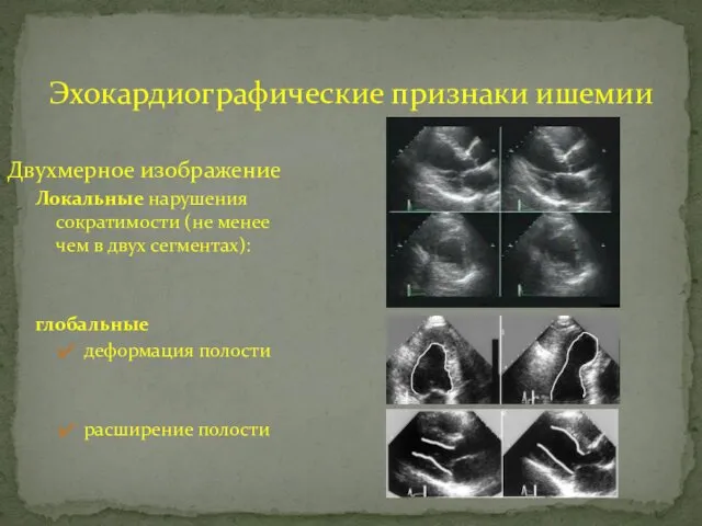 Эхокардиографические признаки ишемии Двухмерное изображение Локальные нарушения сократимости (не менее чем