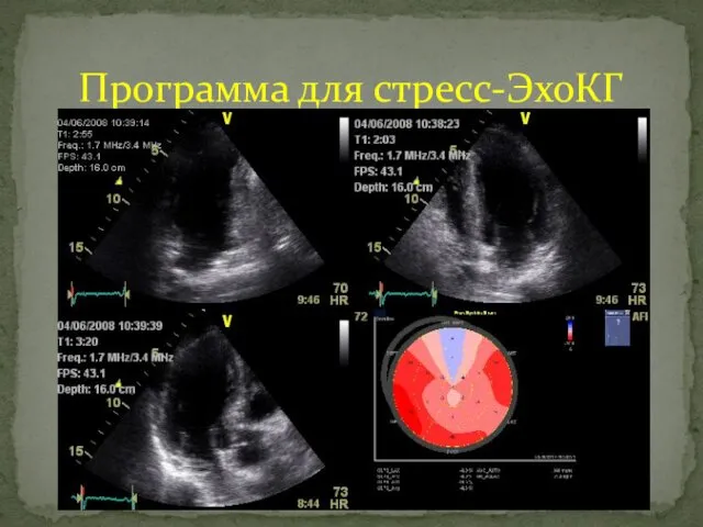 Программа для стресс-ЭхоКГ