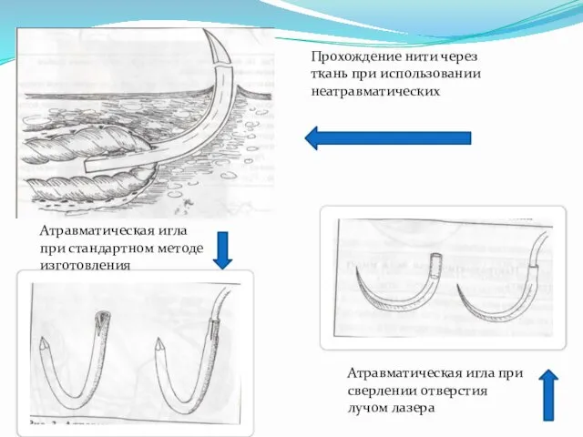 Прохождение нити через ткань при использовании неатравматических Атравматическая игла при стандартном