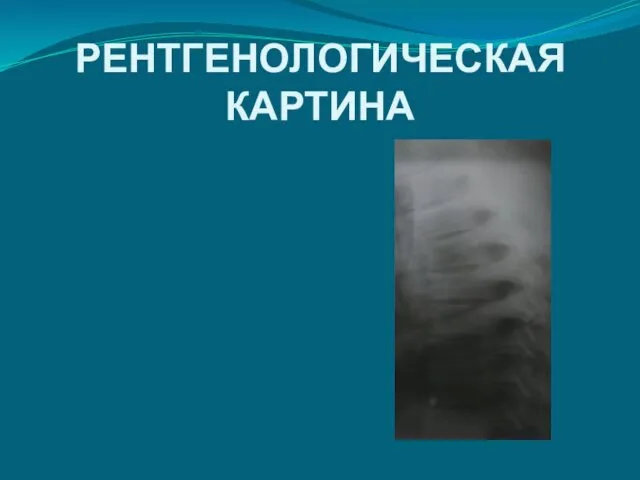 РЕНТГЕНОЛОГИЧЕСКАЯ КАРТИНА