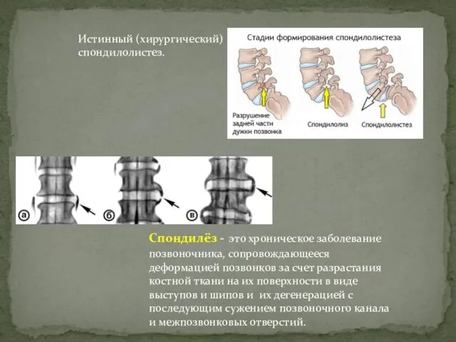 Спондилёз - это хроническое заболевание позвоночника, сопровождающееся деформацией позвонков за счет