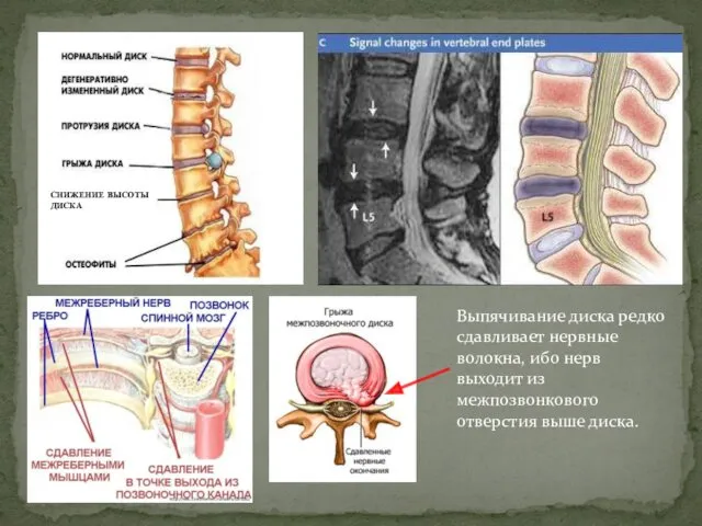 СНИЖЕНИЕ ВЫСОТЫ ДИСКА Выпячивание диска редко сдавливает нервные волокна, ибо нерв