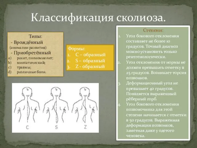 Классификация сколиоза. Типы: - Врождённый (аномалии развития) - Приобретённый рахит, полиомиелит;