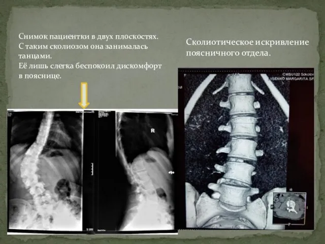 Снимок пациентки в двух плоскостях. С таким сколиозом она занималась танцами.
