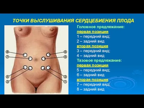 ТОЧКИ ВЫСЛУШИВАНИЯ СЕРДЦЕБИЕНИЯ ПЛОДА Головное предлежание: первая позиция 1 – передний