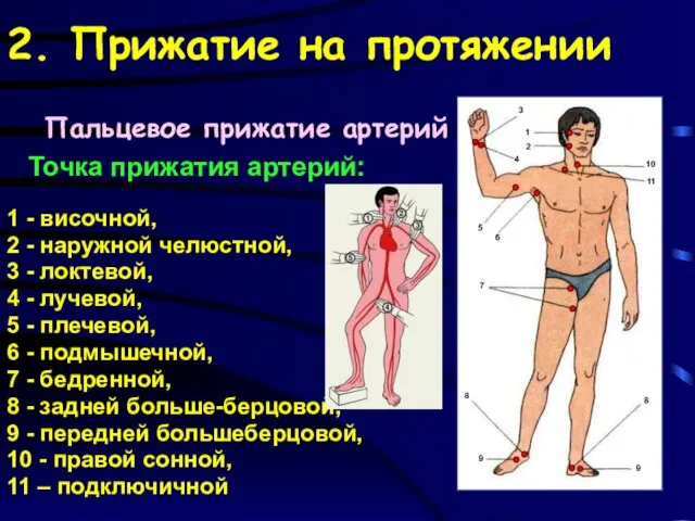 2. Прижатие на протяжении Точка прижатия артерий: 1 - височной, 2