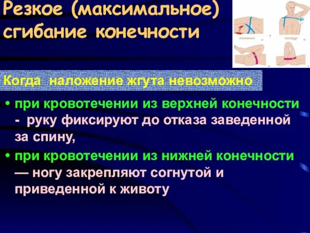 Резкое (максимальное) сгибание конечности при кровотечении из верхней конечности - руку