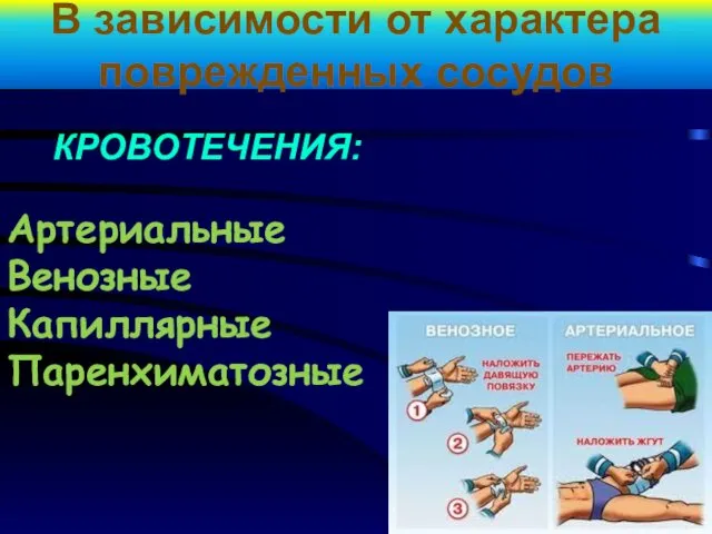 В зависимости от характера поврежденных сосудов Артериальные Венозные Капиллярные Паренхиматозные КРОВОТЕЧЕНИЯ: