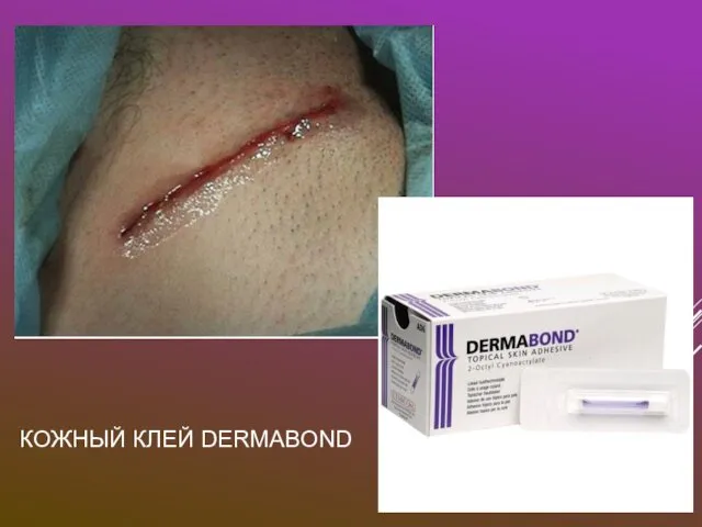 КОЖНЫЙ КЛЕЙ DERMABOND