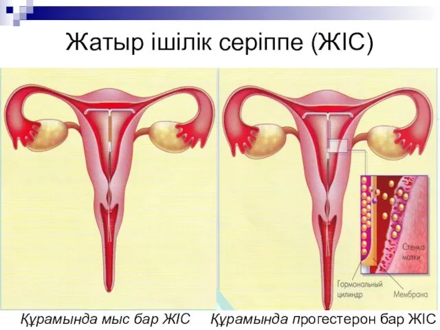 Жатыр ішілік серіппе (ЖІС) Құрамында мыс бар ЖІС Құрамында прогестерон бар ЖІС