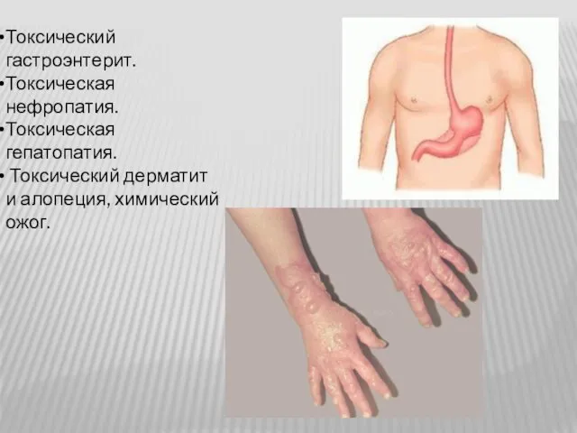 Токсический гастроэнтерит. Токсическая нефропатия. Токсическая гепатопатия. Токсический дерматит и алопеция, химический ожог.